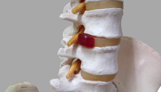 腰椎椎間板の模型